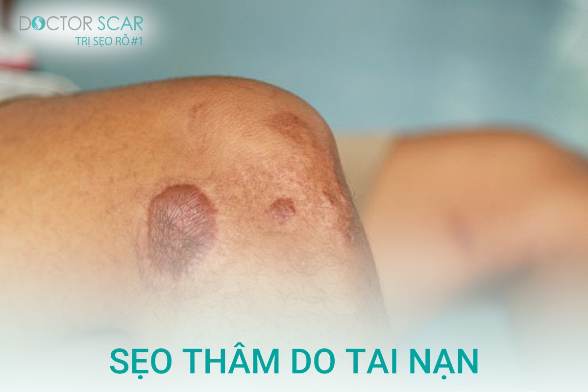 cách trị sẹo thâm sau tai nạn