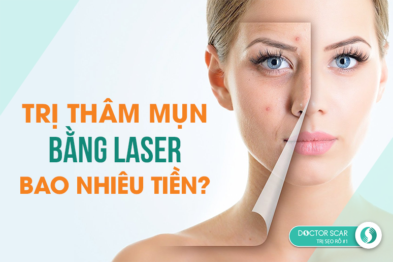 Trị thâm mụn bằng laser bao nhiêu tiền