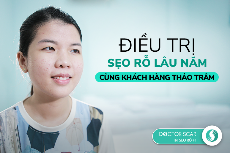 Điều trị sẹo rỗ lâu năm cùng khách hàng Thảo Trâm