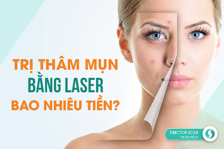 Trị thâm mụn bằng Laser bao nhiêu tiền?