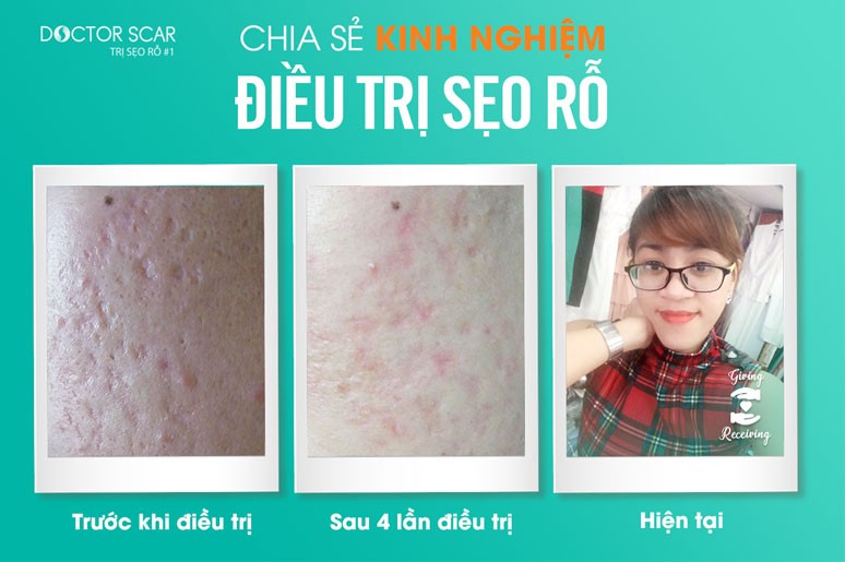 Chia sẻ kinh nghiệm điều trị sẹo rỗ: Hoàng Thị Thúy Liễu