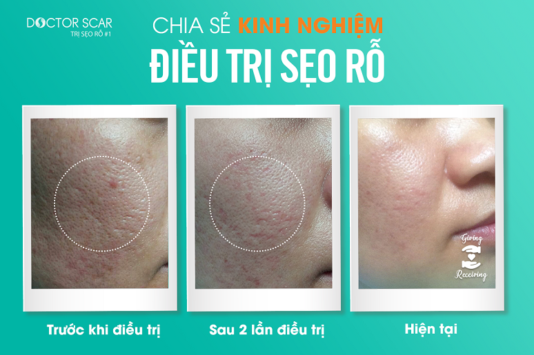 Chia sẻ kinh nghiệm điều trị sẹo rỗ - điều trị sẹo rỗ trong bao lâu? 