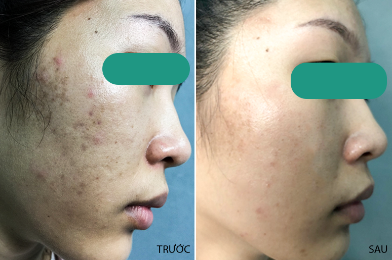 Quy trình Lăn kim điều trị sẹo rỗ tại Phòng Khám Da Liễu Doctor Scar