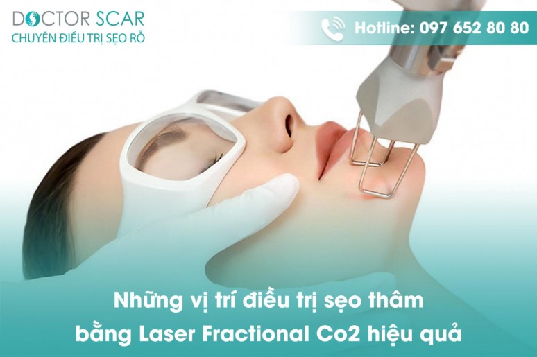 Vì sao bắn laser trị sẹo rỗ, sẹo thâm được bác sĩ đánh giá an toàn